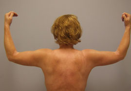 Brachioplasty Before & After Image