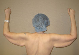 Brachioplasty Before & After Image