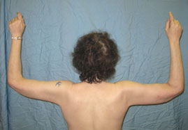 Brachioplasty Before & After Image