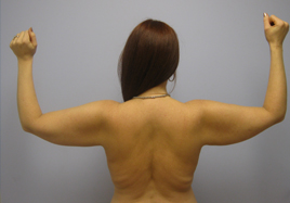 Brachioplasty Before & After Image