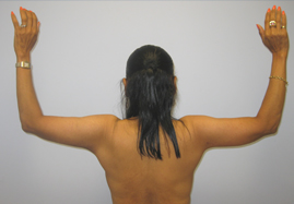 Brachioplasty Before & After Image