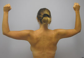 Brachioplasty Before & After Image