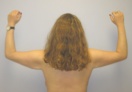 Brachioplasty Before & After Image