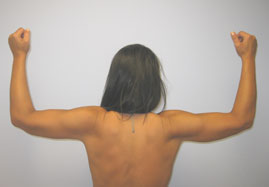 Brachioplasty Before & After Image