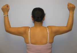 Brachioplasty Before & After Image