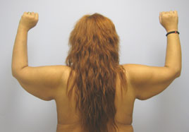 Brachioplasty Before & After Image