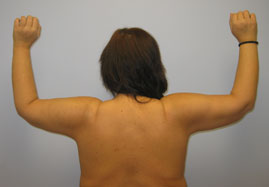 Brachioplasty Before & After Image