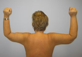 Brachioplasty Before & After Image