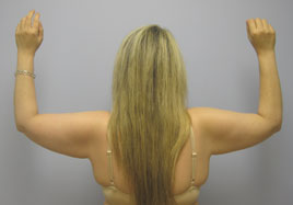 Brachioplasty Before & After Image