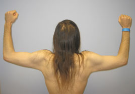 Brachioplasty Before & After Image