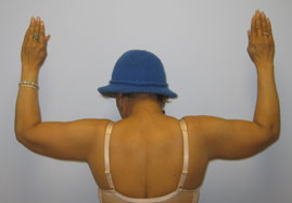 Brachioplasty Before & After Image