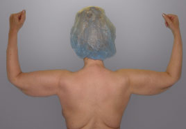 Brachioplasty Before & After Image