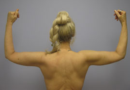 Brachioplasty Before & After Image