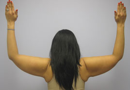 Brachioplasty Before & After Image