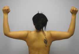 Brachioplasty Before & After Image