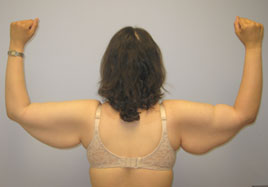 Brachioplasty Before & After Image