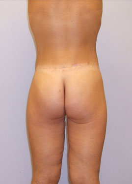 Inner Thigh Lift Before & After Image