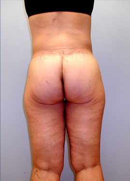 Inner Thigh Lift Before & After Image