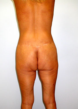 Inner Thigh Lift Before & After Image