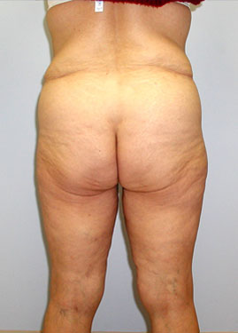 Inner Thigh Lift Before & After Image