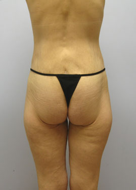 Inner Thigh Lift Before & After Image