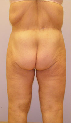 Inner Thigh Lift Before & After Image