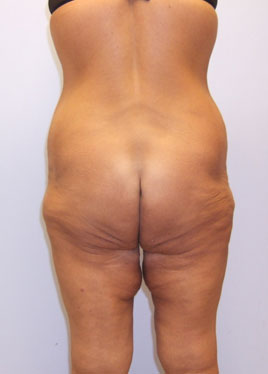 Inner Thigh Lift Before & After Image