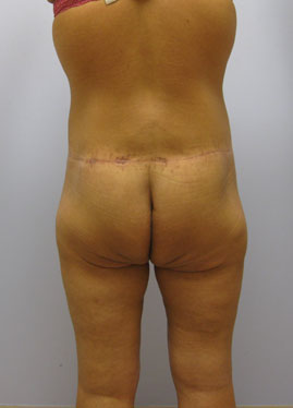 Inner Thigh Lift Before & After Image