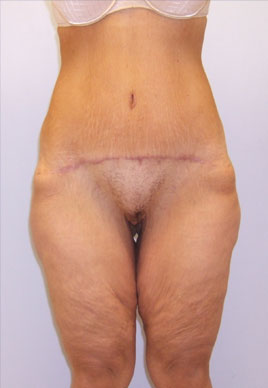 Inner Thigh Lift Before & After Image