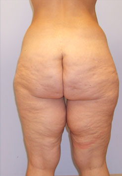 Inner Thigh Lift Before & After Image