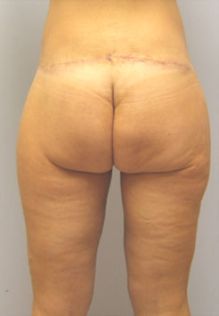 Inner Thigh Lift Before & After Image