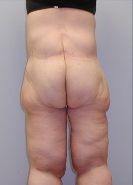 Inner Thigh Lift Before & After Image