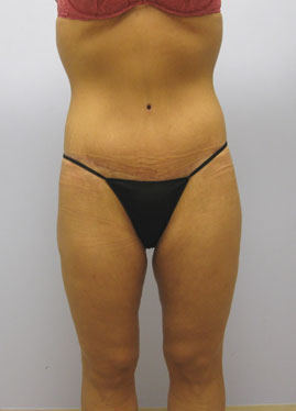 Inner Thigh Lift Before & After Image