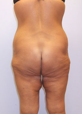 Inner Thigh Lift Before & After Image