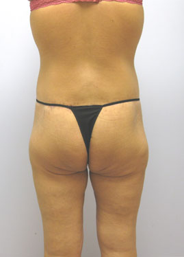 Inner Thigh Lift Before & After Image