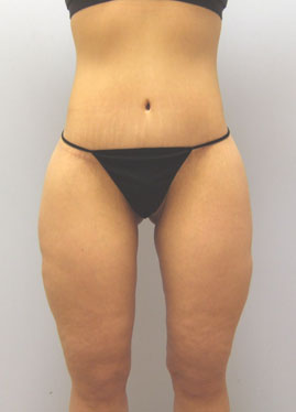 Inner Thigh Lift Before & After Image