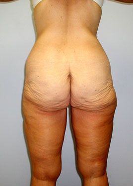 Inner Thigh Lift Before & After Image