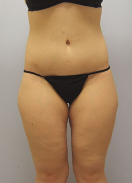 Inner Thigh Lift Before & After Image