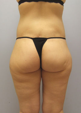 Inner Thigh Lift Before & After Image