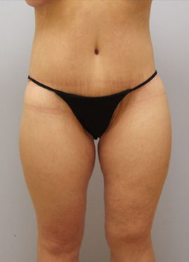 Inner Thigh Lift Before & After Image