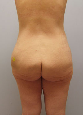 Inner Thigh Lift Before & After Image