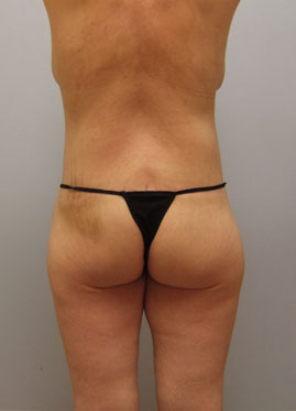 Inner Thigh Lift Before & After Image