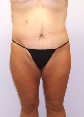 Inner Thigh Lift Before & After Image