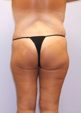 Inner Thigh Lift Before & After Image