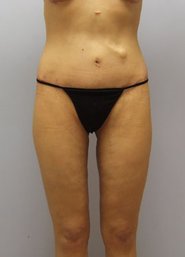 Inner Thigh Lift Before & After Image