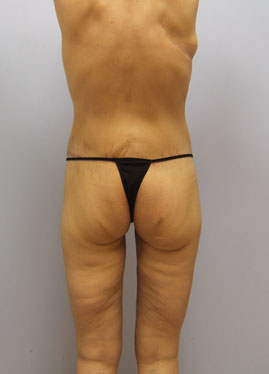 Inner Thigh Lift Before & After Image