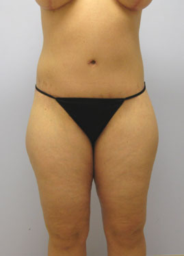 Inner Thigh Lift Before & After Image