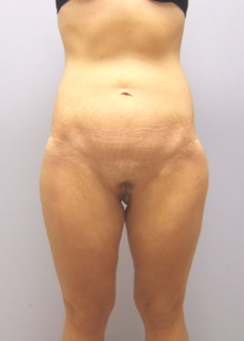 Inner Thigh Lift Before & After Image