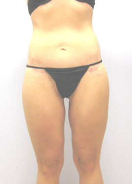 Inner Thigh Lift Before & After Image