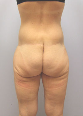 Inner Thigh Lift Before & After Image